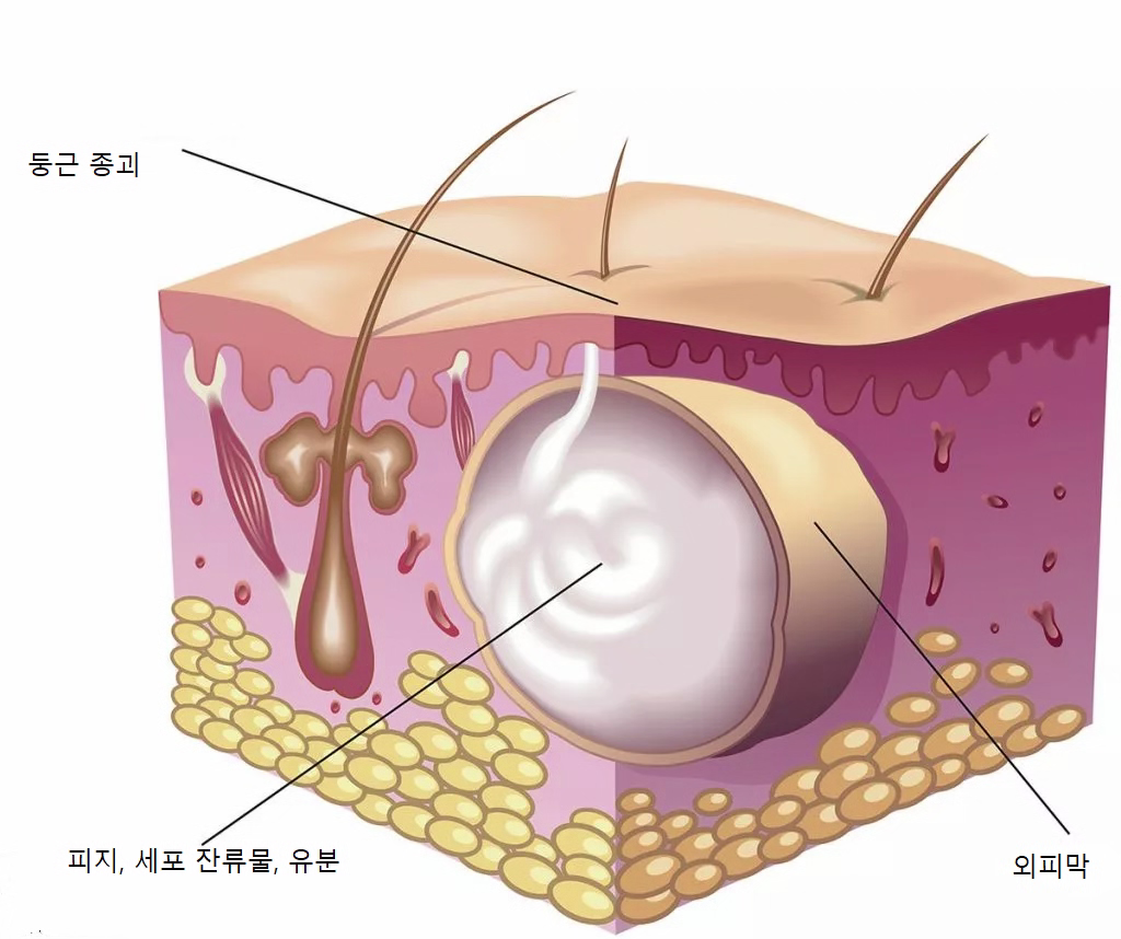 표피낭 단면 구조 - 둥근 종괴, 외피막, 피지 세포 잔류물