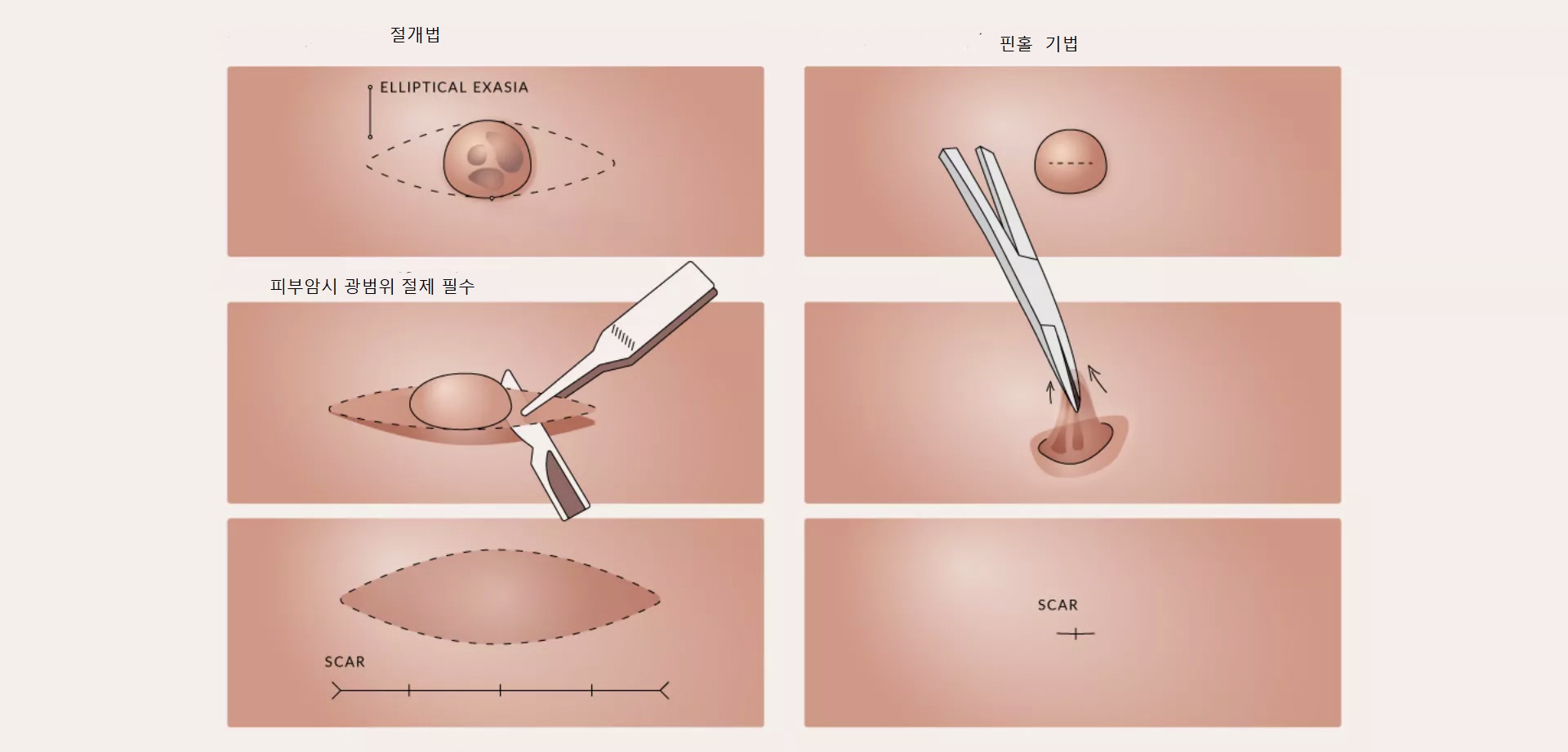 타원형 절개법과 핀홀 기법의 절개 크기 및 흉터 비교